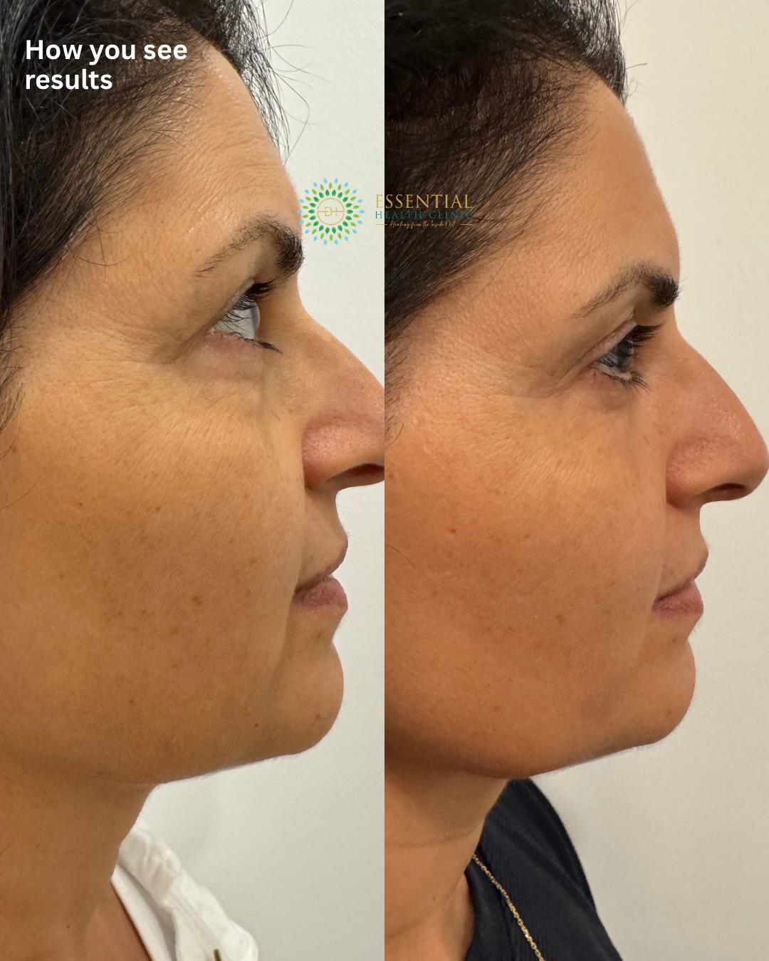 Morpheus8 before-and-after result