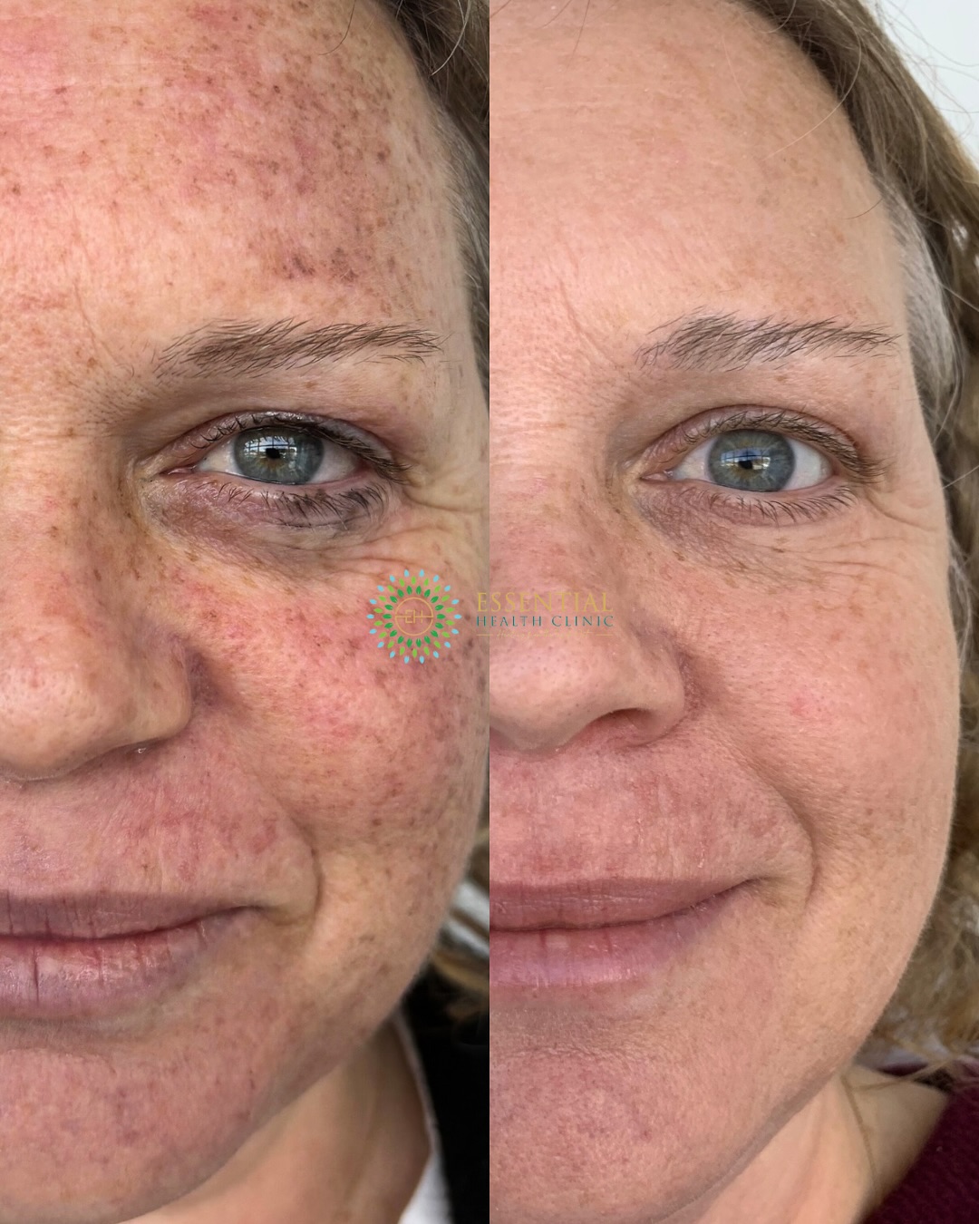Lumecca IPL before-and-after result