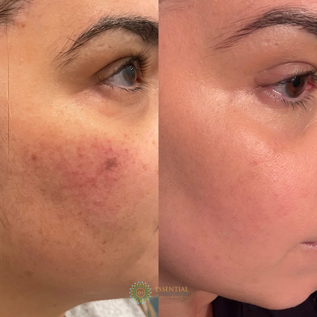 Medical-grade facial before-and-after result
