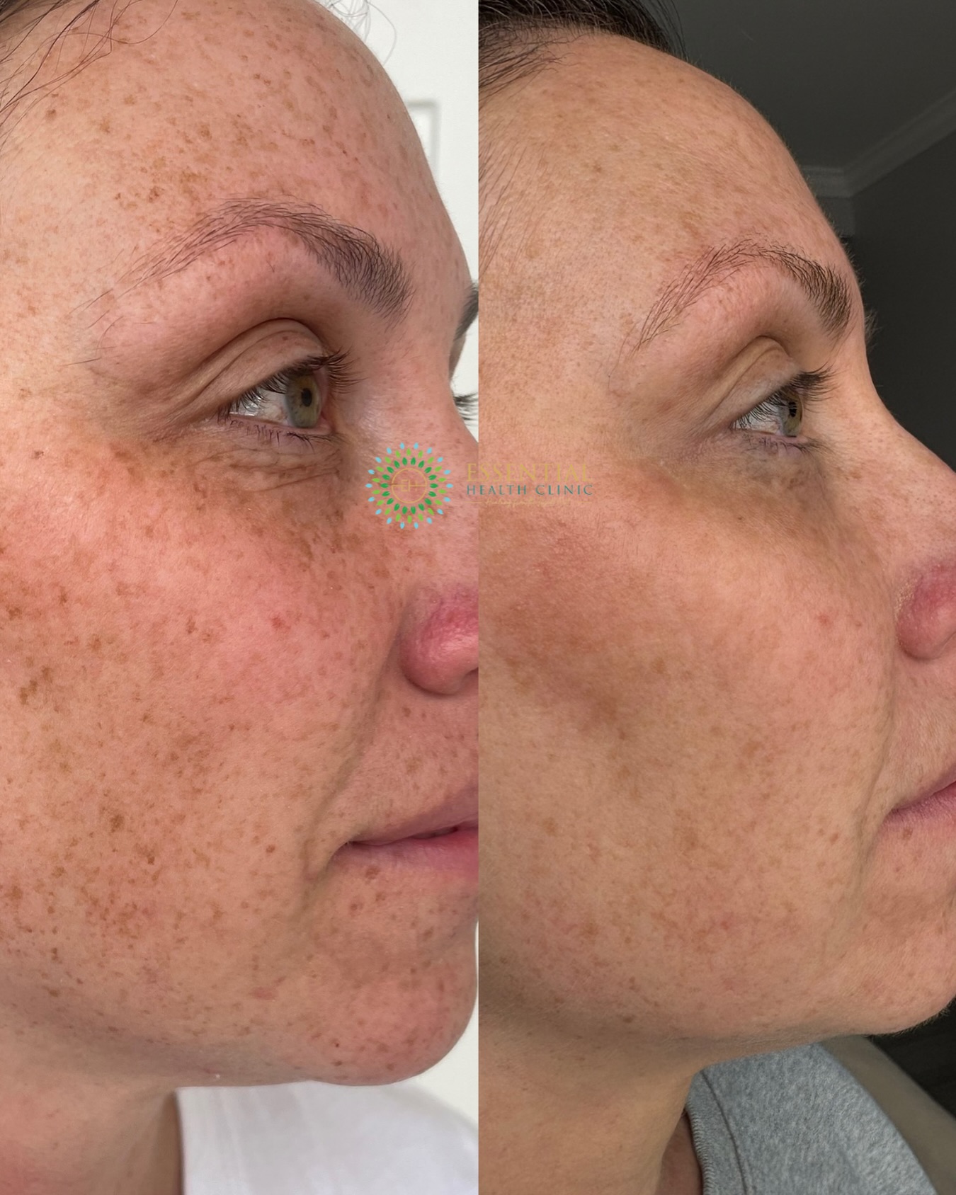 Lumecca IPL before-and-after result