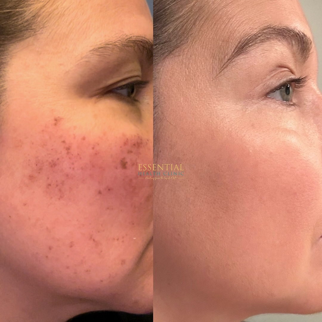 Morpheus8 before-and-after result